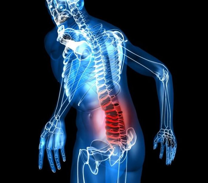 Stopień i etapy rozwoju osteochondrozy lędźwiowej