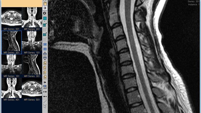 MRI kręgosłupa szyjnego jest najlepszą metodą diagnozowania bólu szyi