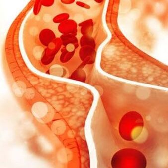 Odkładanie się cholesterolu na wewnętrznych ścianach naczyń krwionośnych powoduje ból w boku szyi
